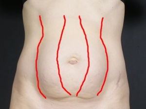 approximate location of my abs before surgery